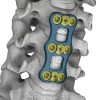 WALEN颈椎前路钢板系统