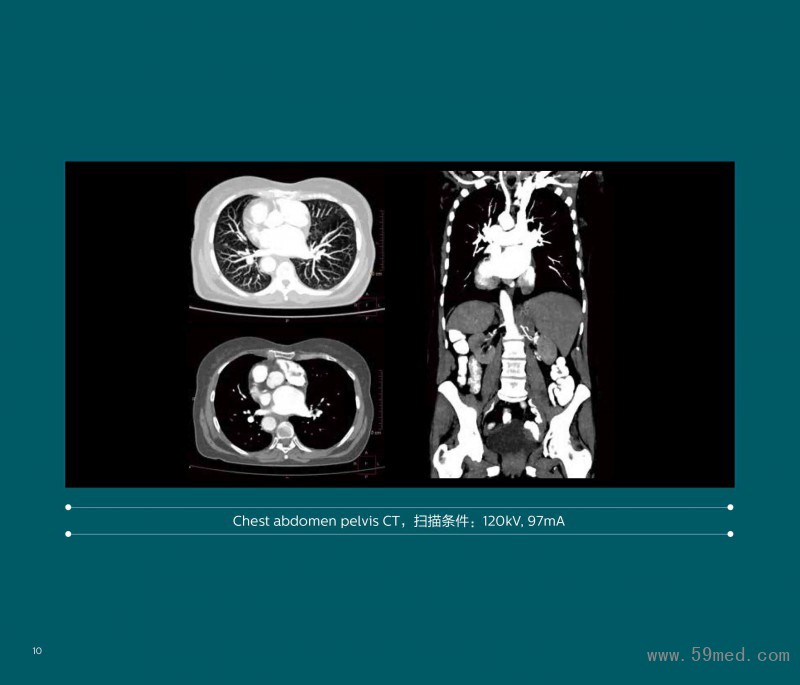 2020-CT-0018-V1---智惠尊享 晨光CT-飞利浦64层Incisive CT_196-10