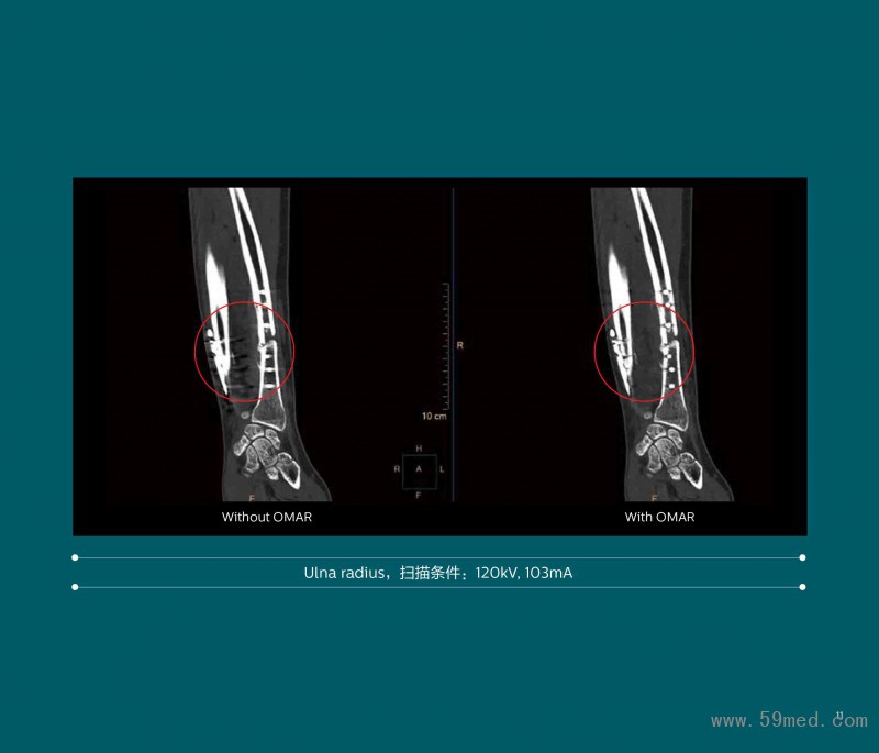 2020-CT-0018-V1---智惠尊享 晨光CT-飞利浦64层Incisive CT_196-11